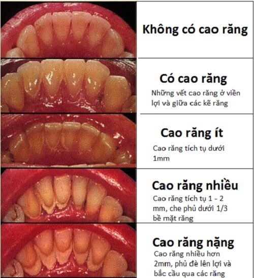 Cấp độ cao răng từ không tới nặng