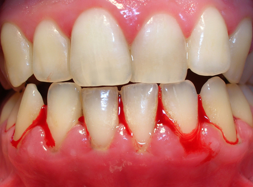 Hình ảnh giới thiệu về tình trạng viêm nướu răng