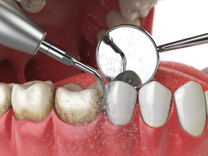 Hình ảnh mô phỏng cạo vôi răng tại Nha khoa SV quận 3