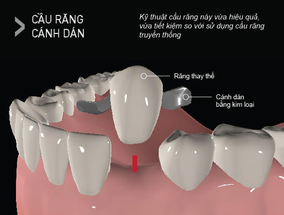 Hình ảnh cầu răng sứ có cánh dán