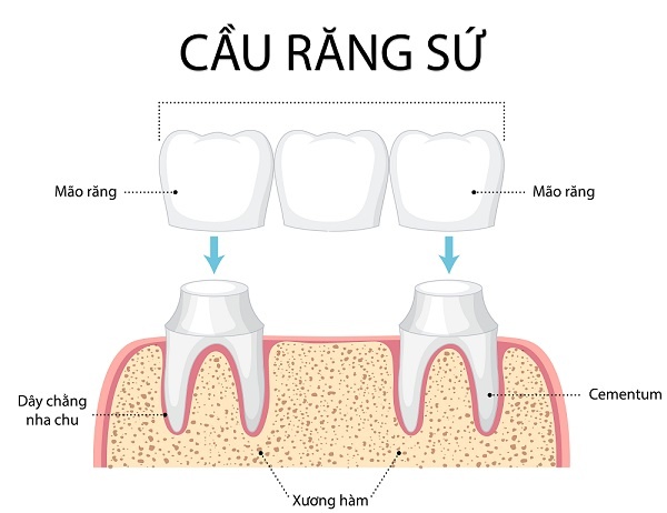Hình ảnh giới thiệu về cầu răng sứ