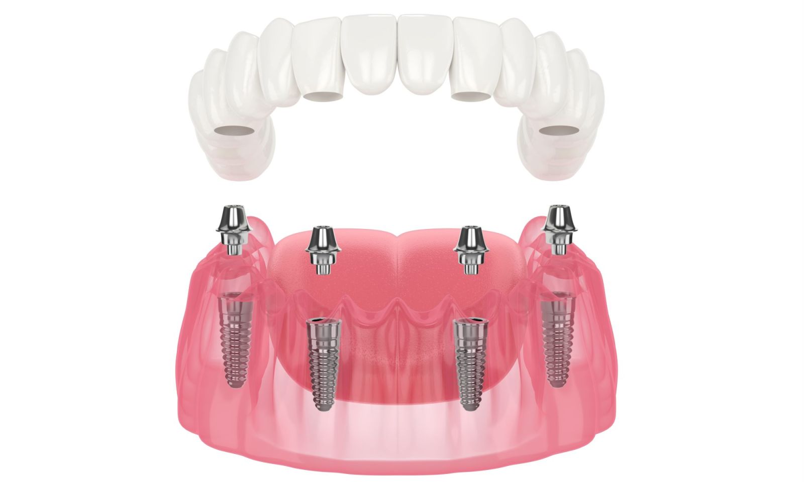 Trồng răng Implant All On 4