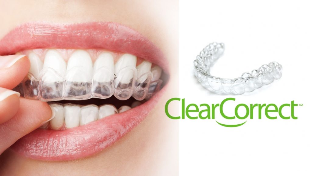 Hình ảnh về loại niềng răng trong suốt ClearCorrect