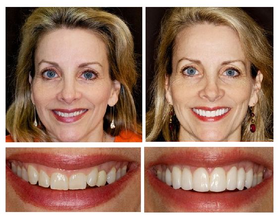 Ảnh kết quả từ khách hàng bị hư khe răng kẻ trước và sau khi dán veneer, tẩy trắng.