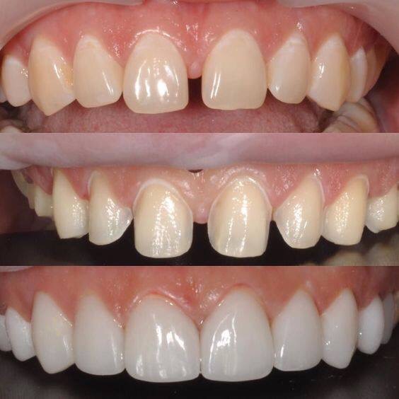Dán sứ Veneer giúp tăng cường sự tự tin cho nụ cười