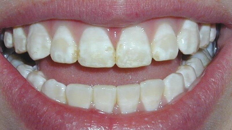 Hình ảnh răng xuất hiện các vết đốm do men răng bị hỏng