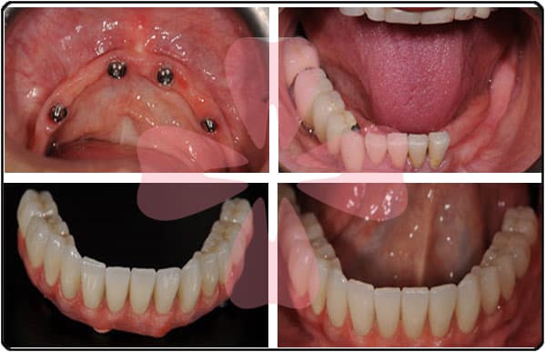 Trồng răng Implant All On 4 tại Nha khoa SV quận 3