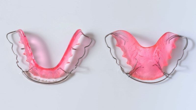 Hình ảnh hàm duy trì tháo lắp bằng kim loại