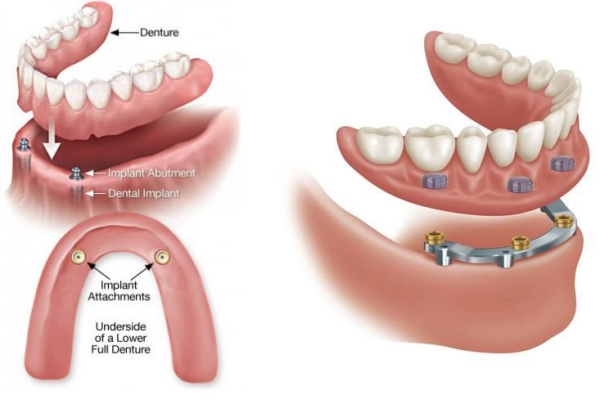 Trồng răng Implant All On 4 áp dụng cho bệnh nhân mất toàn bộ răng trên hoặc cả 2 hàm