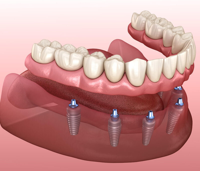 Hàm tháo lắp trên Implant không có thanh bar