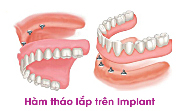 Hình ảnh hàm tháo lắp trên Implant tại Nha khoa SV quận 3 
