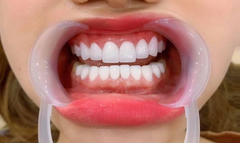 Hình ảnh giới thiệu về răng sứ thẩm mỹ là gì?