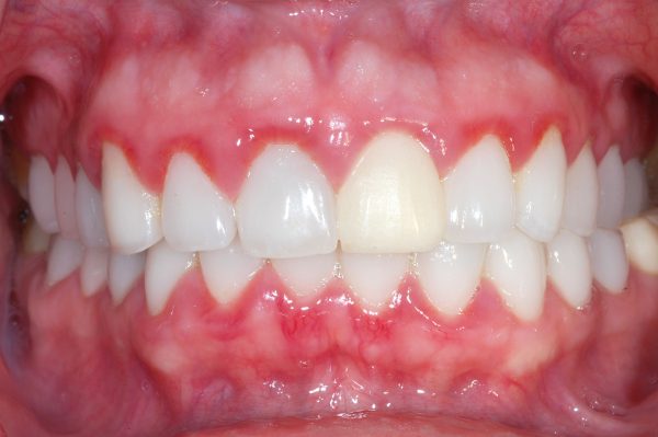 Viêm nướu là tiền thân của bệnh nha chu- Nha khoa SV quận 3
