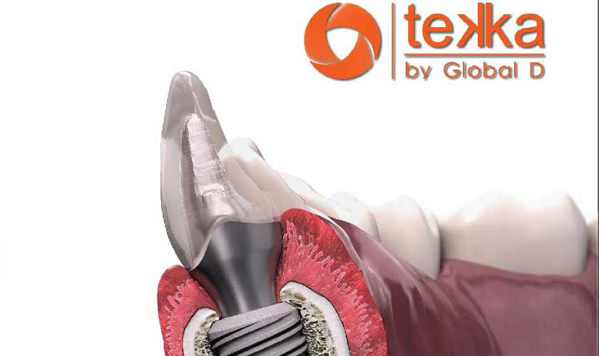 Hình ảnh mô phỏng trồng trụ implant Tekka Pháp