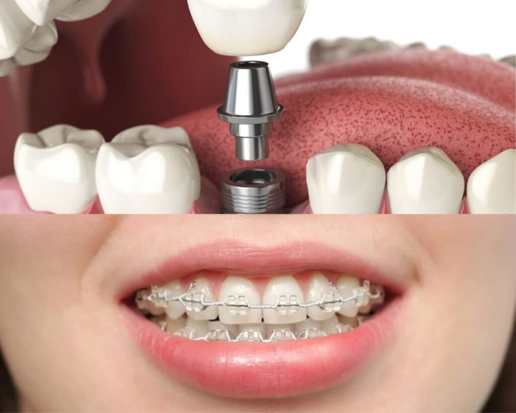 Hình ảnh dịch vụ trồng răng Implant uy tín tại quận 3, TP Hồ Chí Minh
