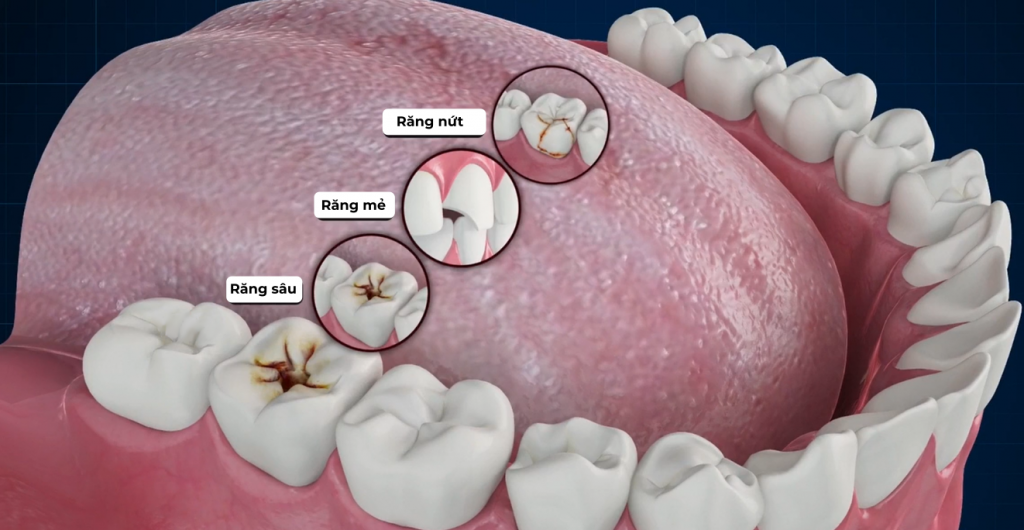 Hình ảnh những trường hợp có thể trám răng composite