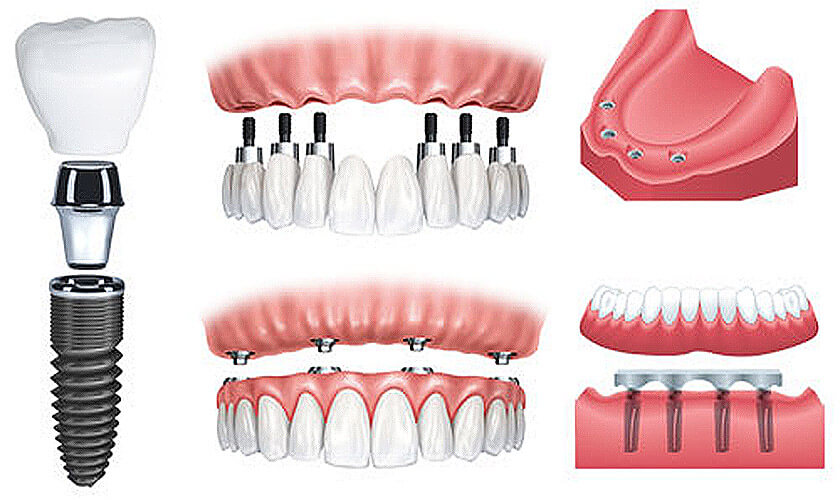 Trồng răng Implant All On 6 giúp cải thiện chức năng nhai
