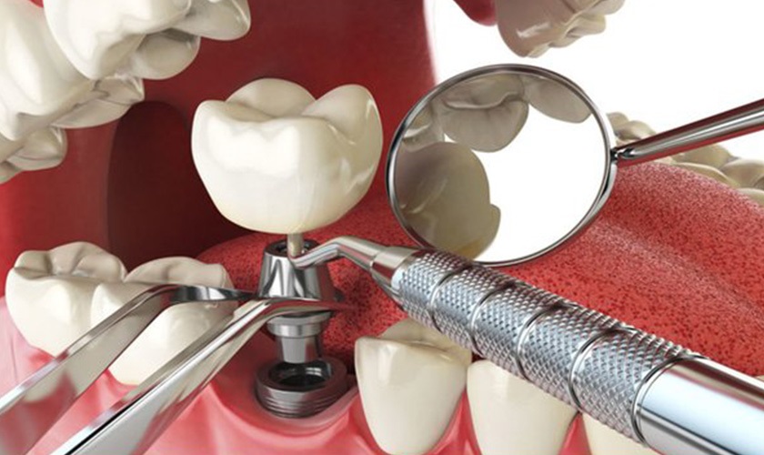 Đặc điểm cấu tạo của trụ Implant Nobel TiUltra