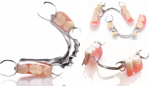 Hàm tháo lắp bằng khung kim loại tại Nha khoa SV quận 3 
