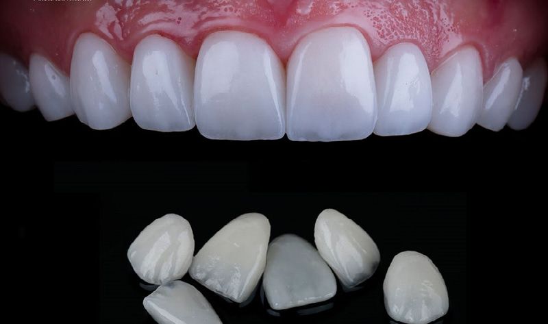Mặt dán sứ Veneer Lisi có tốt không?