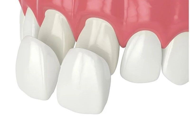 Mặt dán sứ Veneer Lisi: Nha khoa SV quận 3