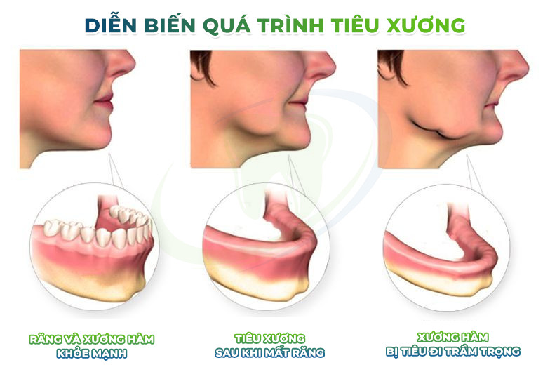Người lớn tuổi mất răng có nguy cơ cao bị tiêu xương hàm