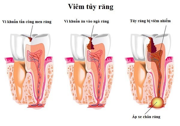 Nguyên nhân gây viêm tủy răng 