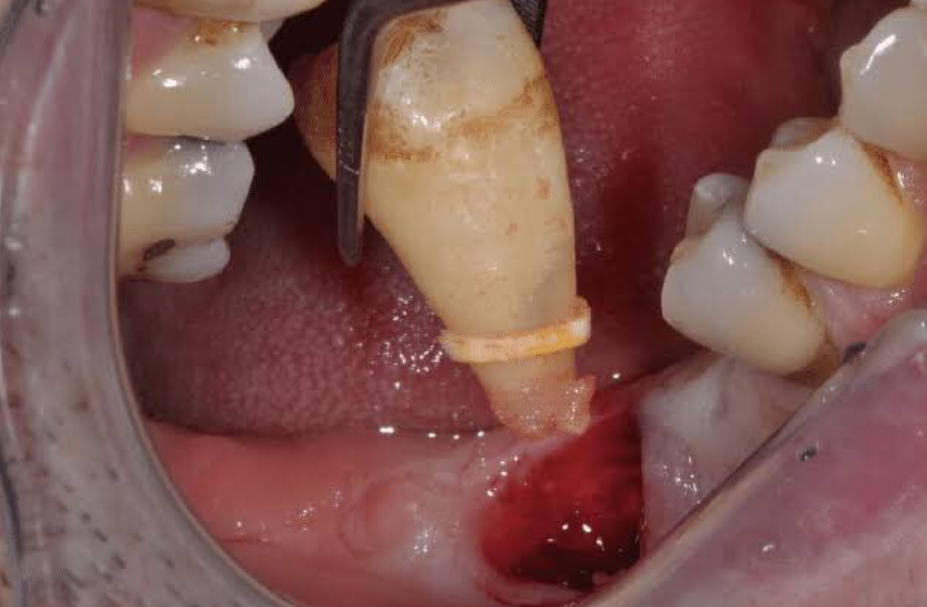 Răng khôn gây ra nhiều biến chứng nguy hiểm nếu không điều trị kịp thời