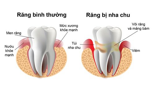 Hình ảnh mô phỏng răng bị viêm nha chu- Nha khoa SV quận 3