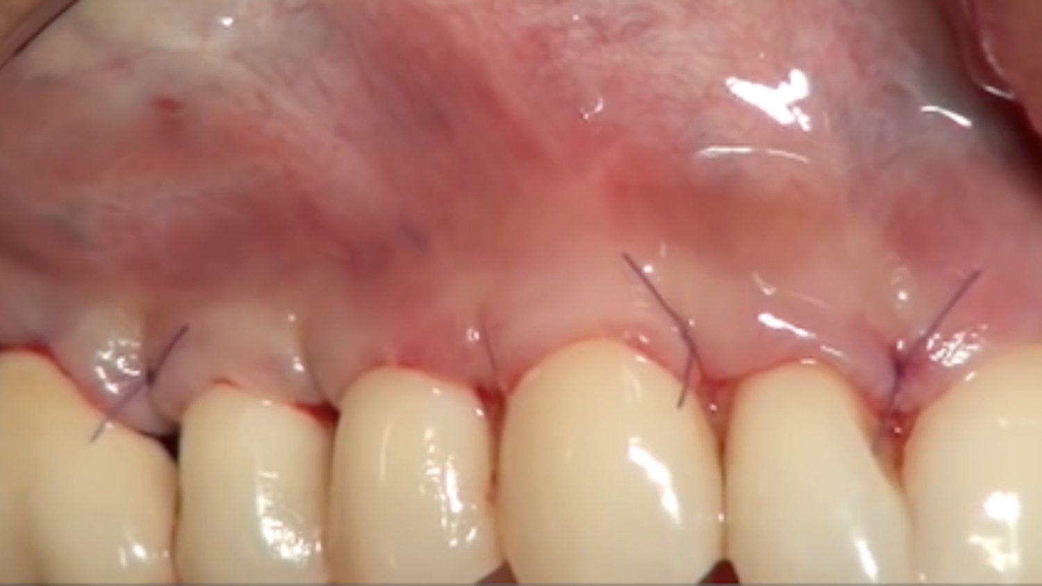 Vì sao cần nạo túi nha chu