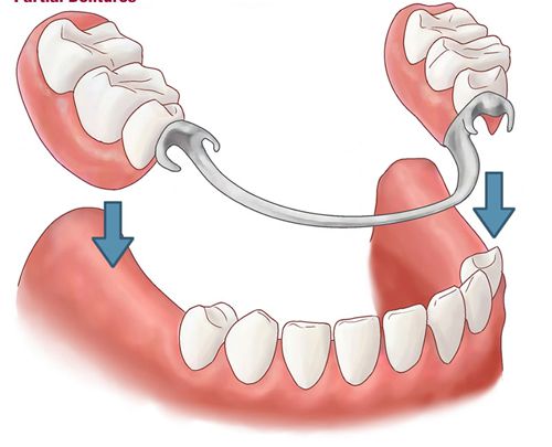 Hình ảnh giới thiệu về Trồng răng giả tháo lắp 