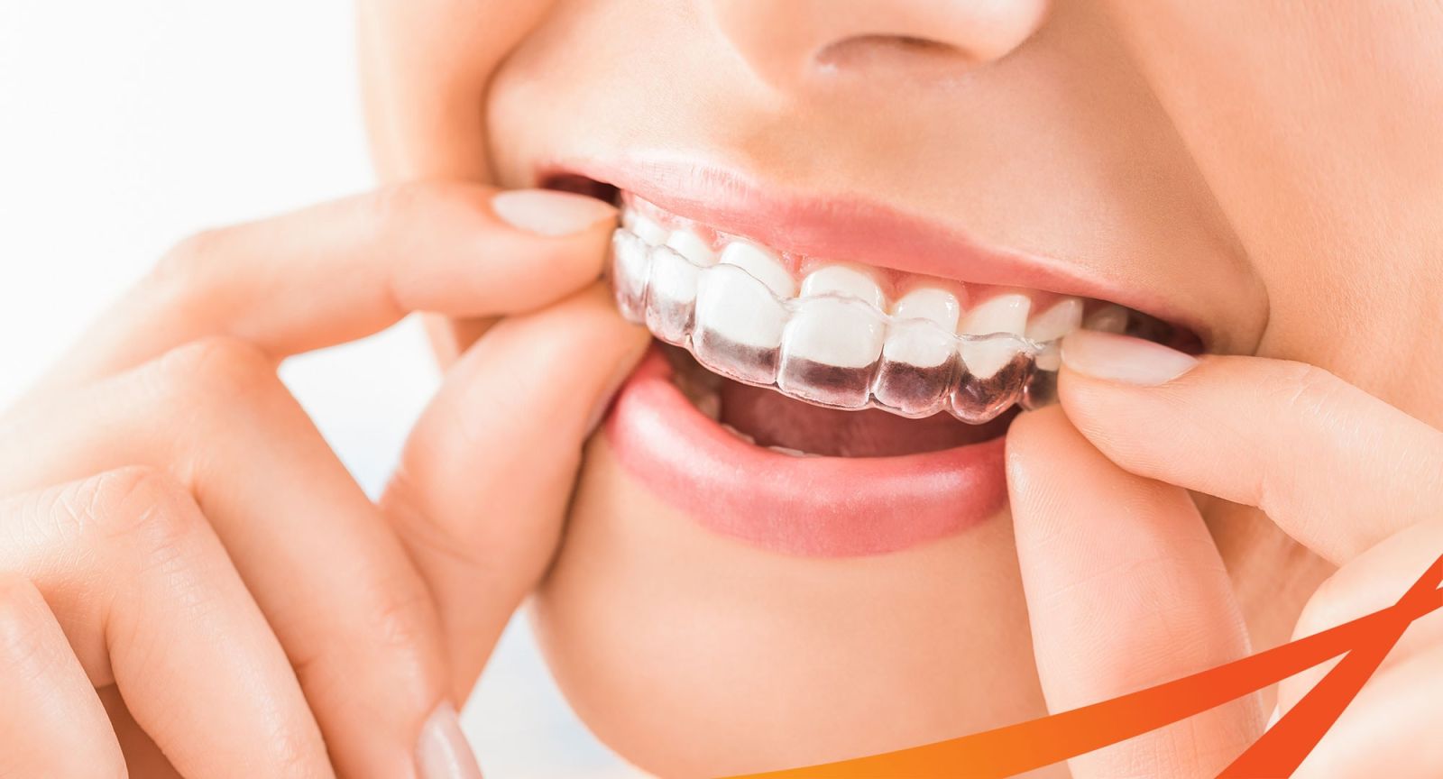 Niềng răng hô nhẹ trong suốt