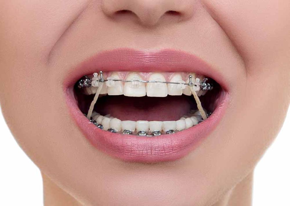 Hình ảnh giới thiệu về phương pháp niềng răng