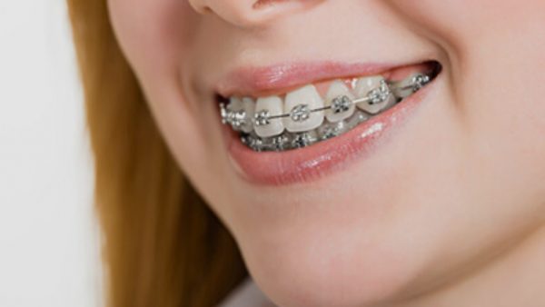 Hình ảnh niềng răng hô nhẹ mắc cài kim loại 