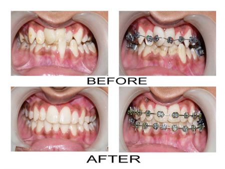 Hình ảnh minh họa các trước hợp nên niềng răng mắc cài kim loại