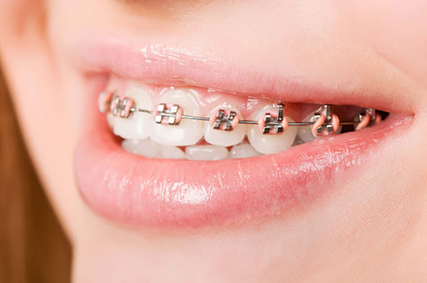 Hình ảnh niềng răn mắc cài tự buộc