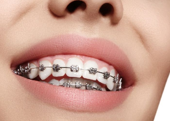 Hình ảnh niềng răng mắc cài tự buộc