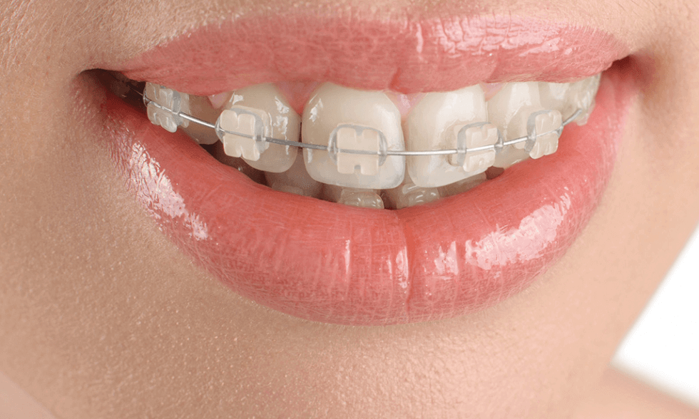 Hình ảnh niềng răng hô nhẹ mắc cài sứ