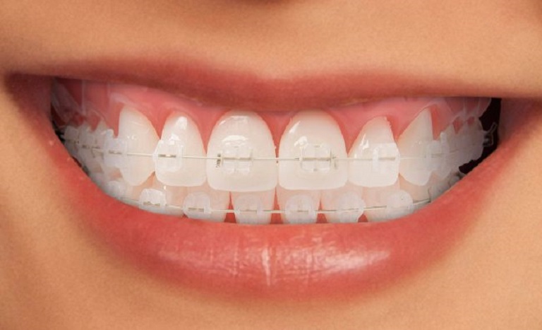 Niềng răng mắc cài sứ tại Nha khoa SV quận 3