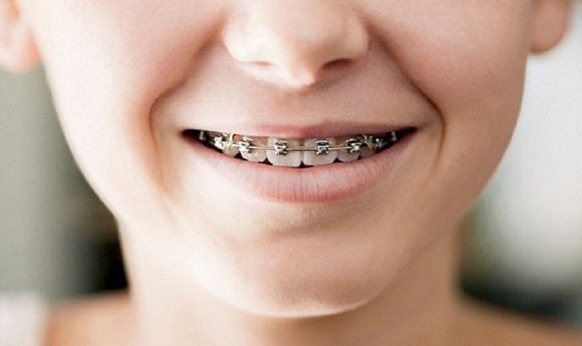Niềng răng là một phương pháp phổ biến điều trị răng mọc lẫy ở trẻ em