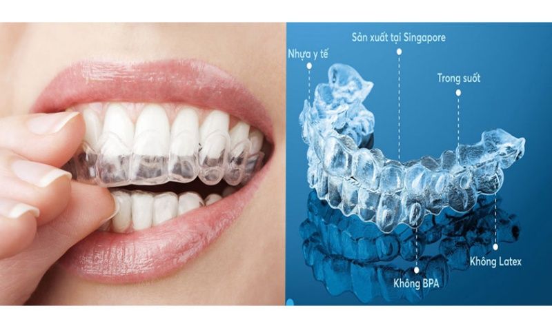 Hình ảnh phương pháp niềng răng trong suốt Invisalign tại Nha khoa SV quận 3