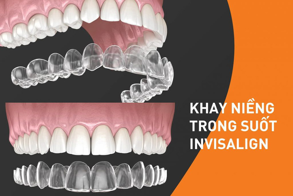 Hình ảnh về niềng răng trong suốt invisalign
