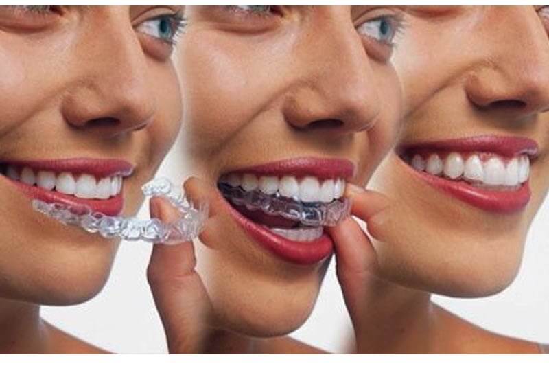 Thời gian niềng răng nhanh hay chậm còn tùy vào việc khách hàng có tuân thủ yêu cầu điều trị hay không