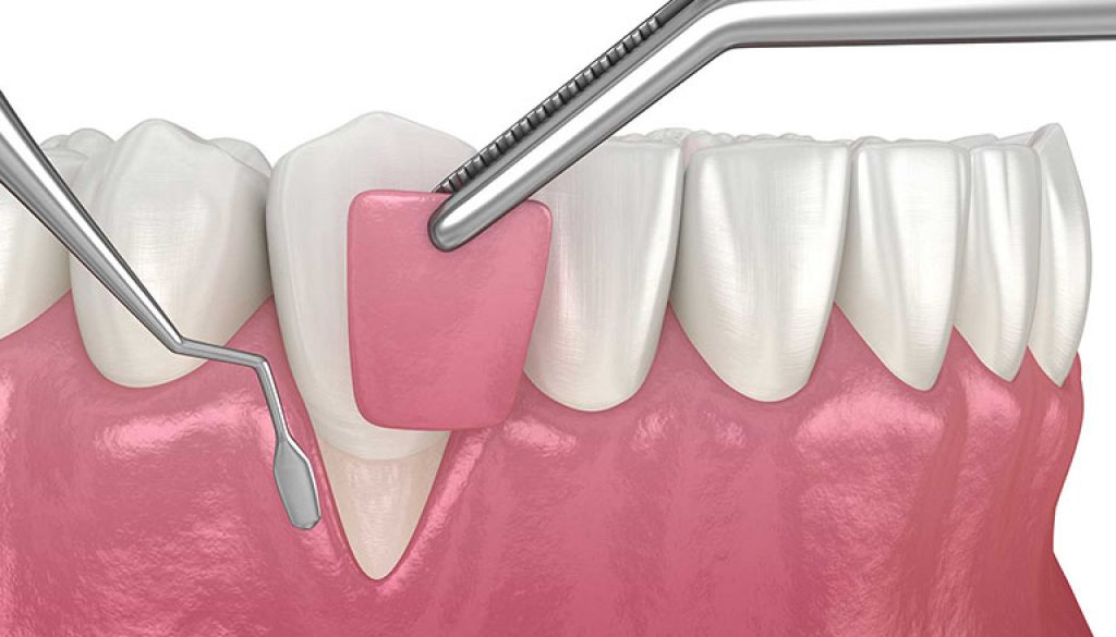 Hình ảnh mô phỏng về phương pháp điều trị ghép nướu