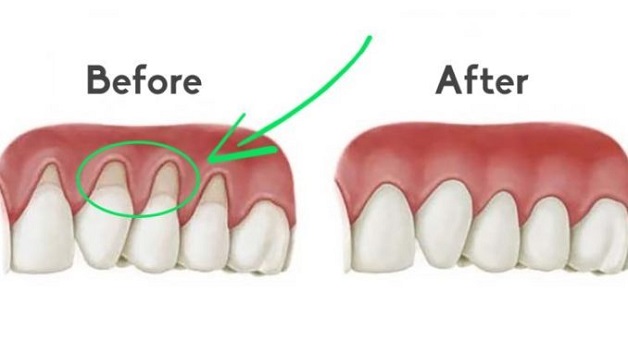 Hình ảnh trước và sau khi ghép nướu