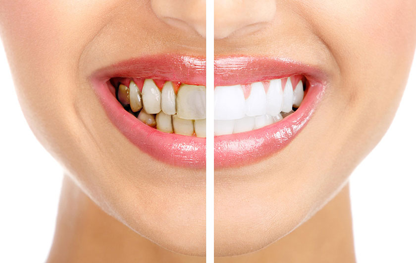 Bọc răng sứ thẩm mỹ là một phương pháp điều trị răng nhiễm Tetracycline