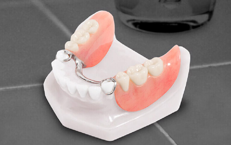 Hình ảnh hàm giả tháo lắp bán phần 