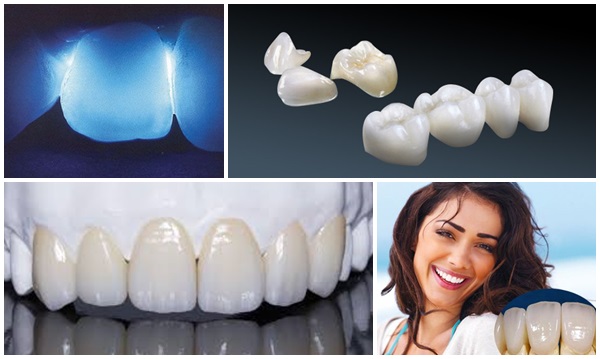 Hình ảnh giới thiệu về răng sứ Cercon: Nha khoa SV quận 3