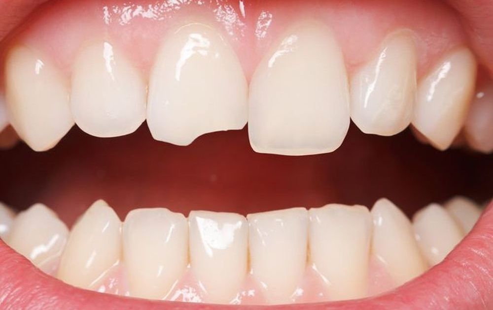 Hình ảnh răng bị mẻ