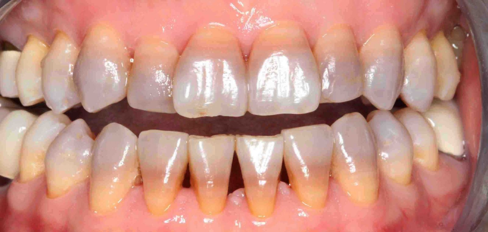 Hình ảnh răng bị xỉn màu